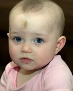 Liesl Has a Bump on Her Noggin
